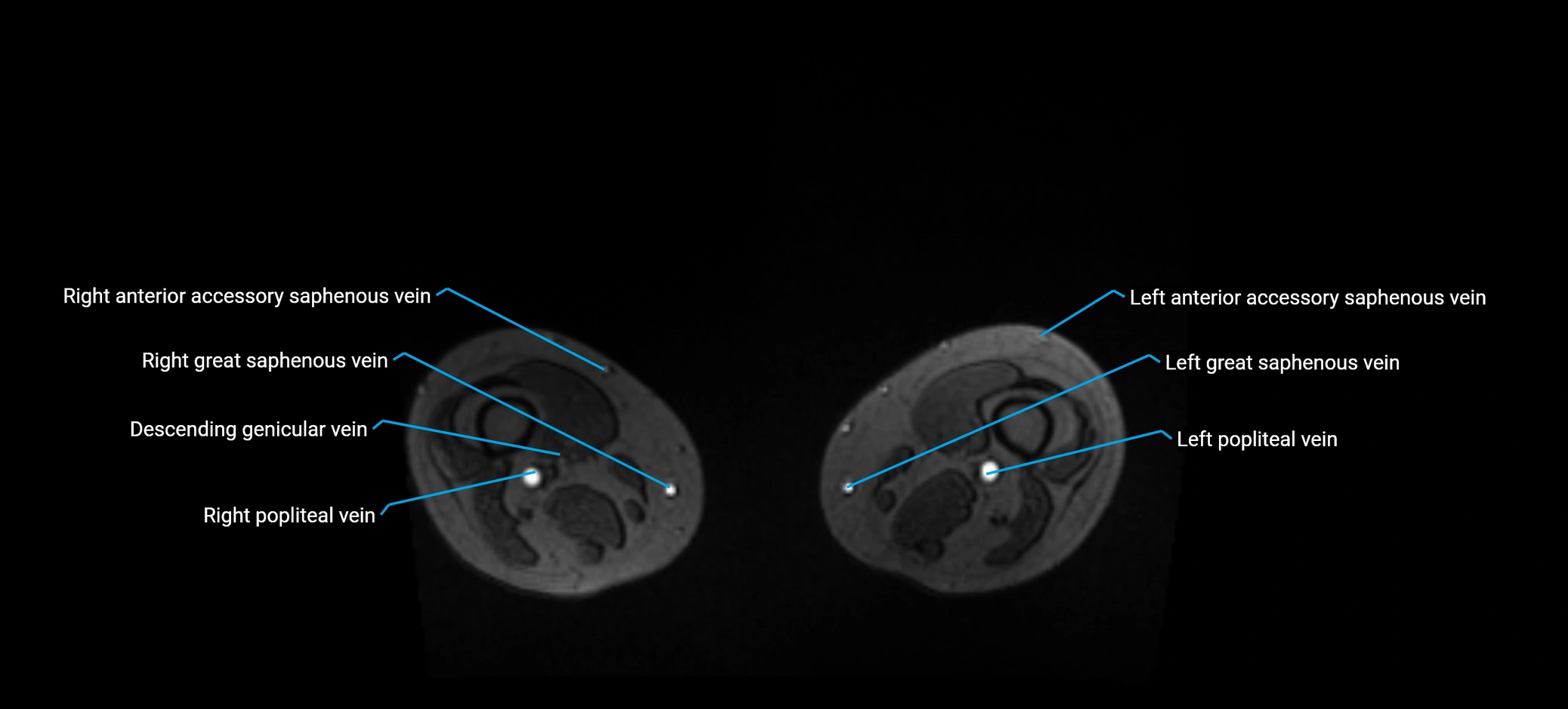 MRV abdomen pelvis & lower limb axial cross sectional anatomy labelled MRI image 329.webp